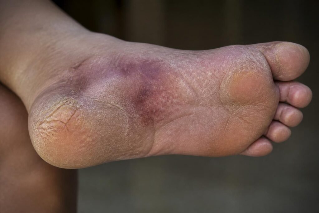 découvrez comment reconnaître les symptômes du diabète des pieds, tels que brûlures, engourdissements et sécheresse, pour mieux prévenir les complications.